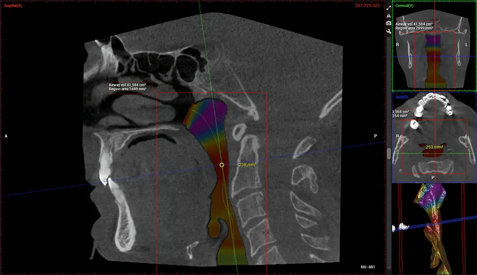 Planmeca CBCT Estudio de vías respiratorias G7 de baja radiación en Miami