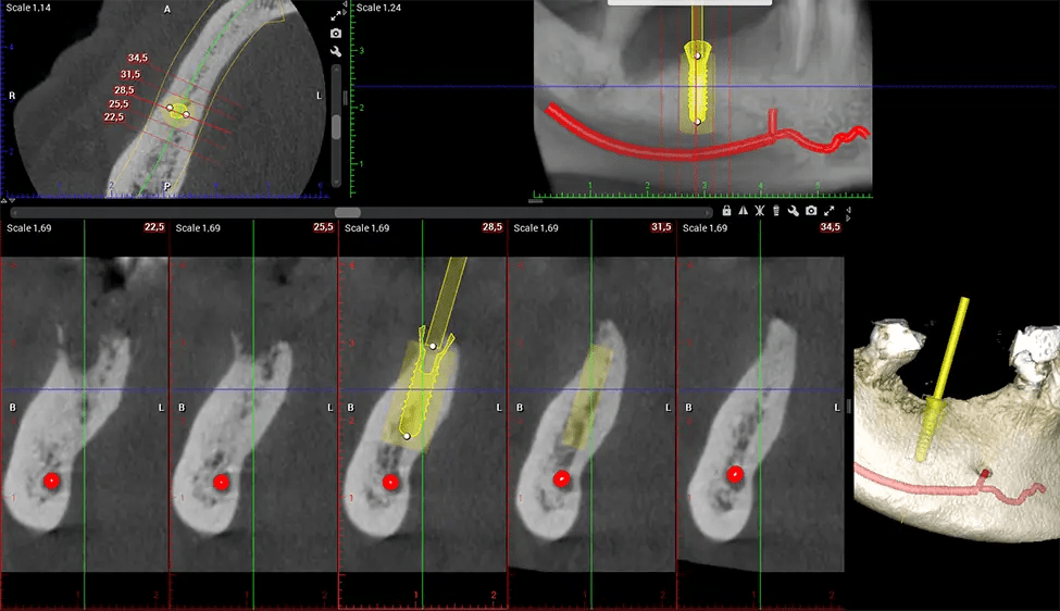 Planmeca CBCT Planificación de implantes G7 de baja radiación